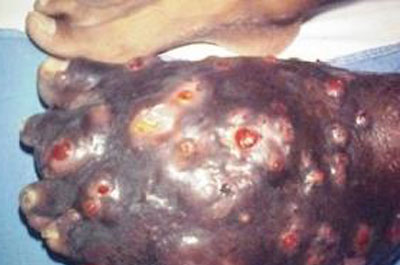 Study brings hope to combat eumycetoma, one of the most neglected diseases in the world