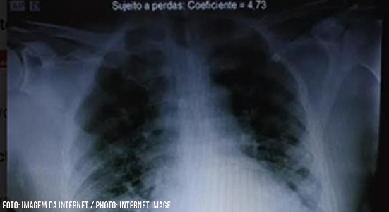 Coronavirus Disease 2019 Infection and Early Diagnosis of Macrophage Activation Syndrome: A Case Report of a 62-year-old man