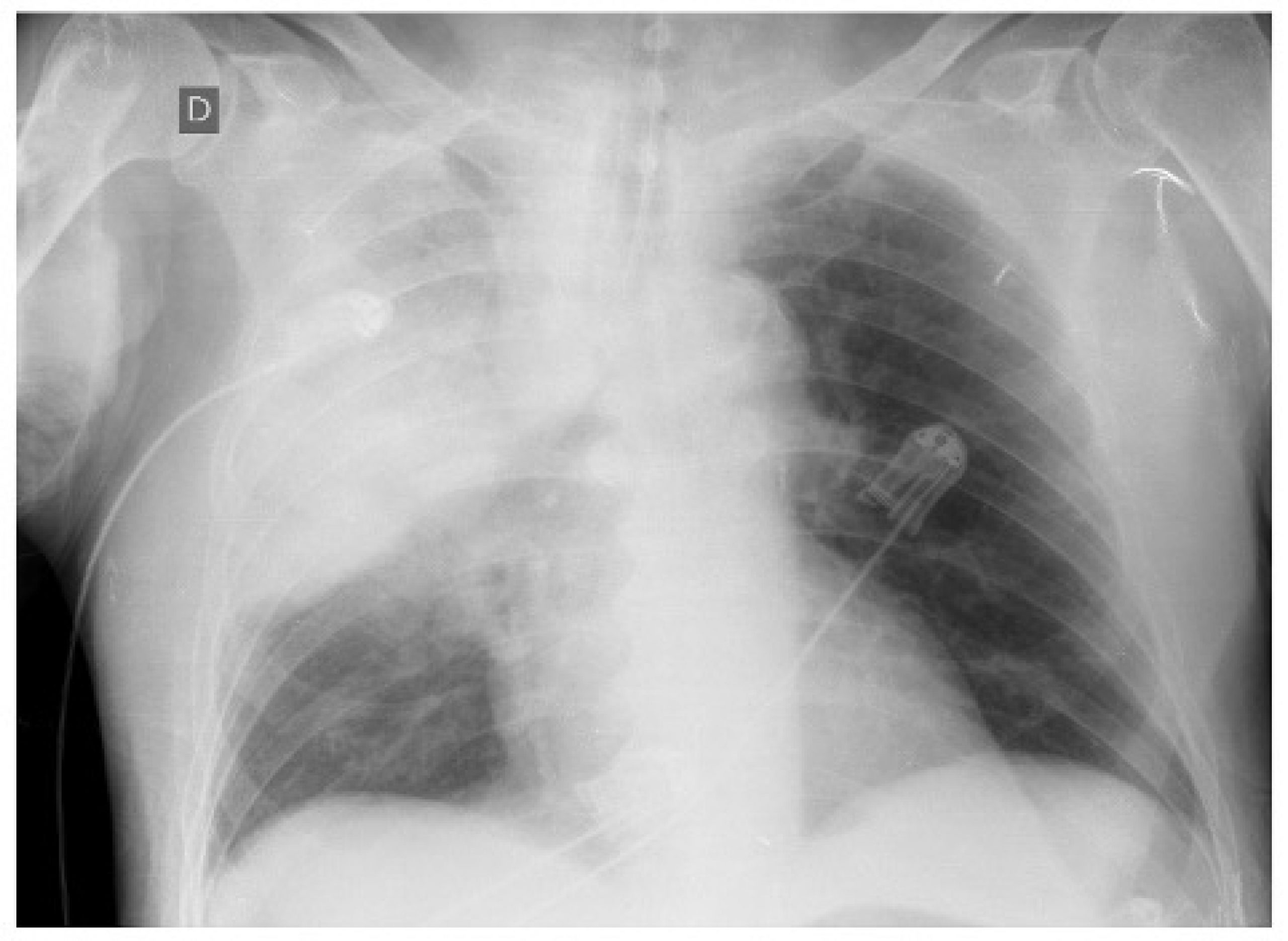 Community-acquired Acinetobacter baumannii pneumonia: a rare case in Brazil: Case Report