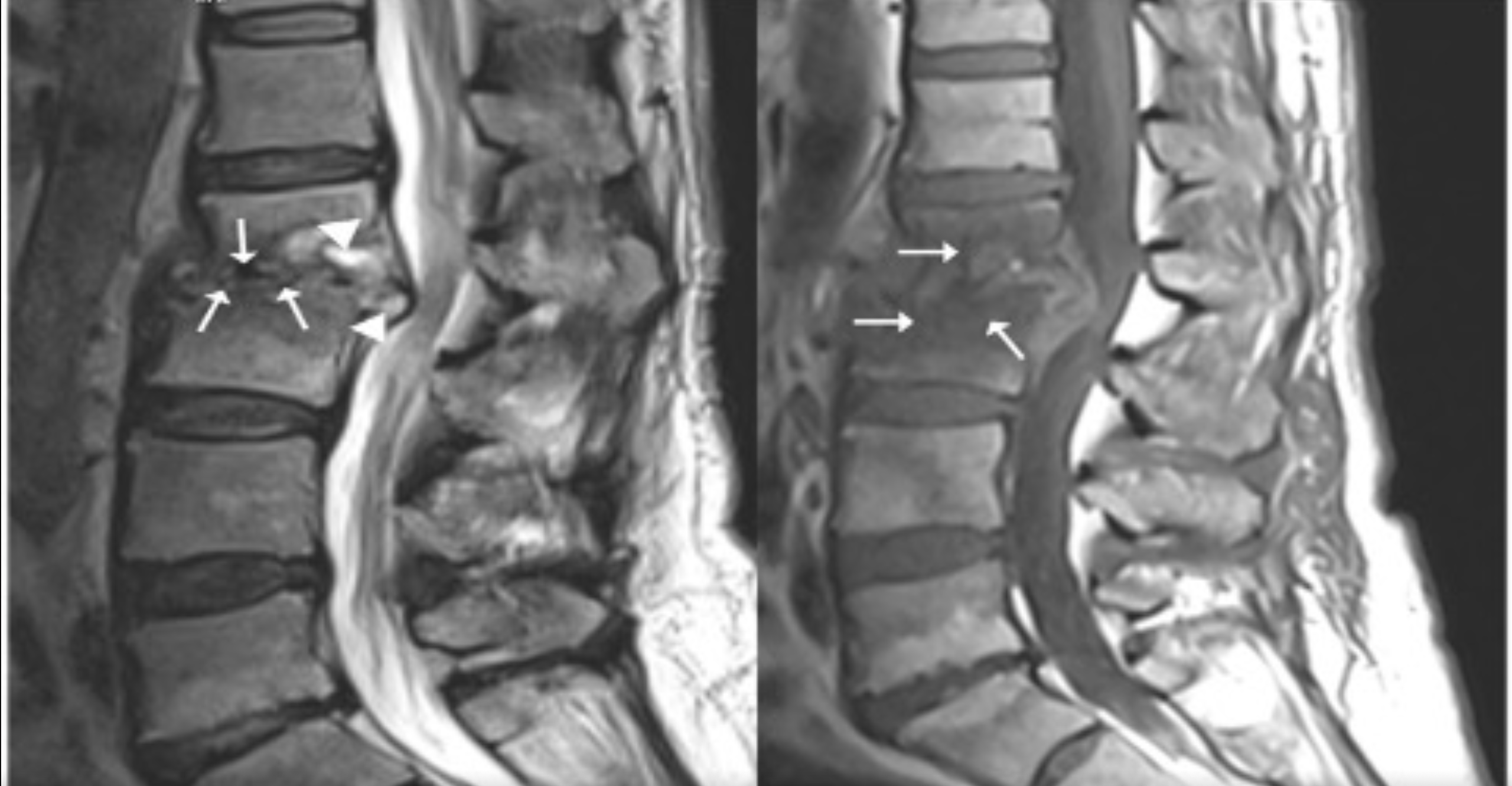 Images In Infectious Diseases: Spondylodiscitis as osteoarticular involvement in brucellosis