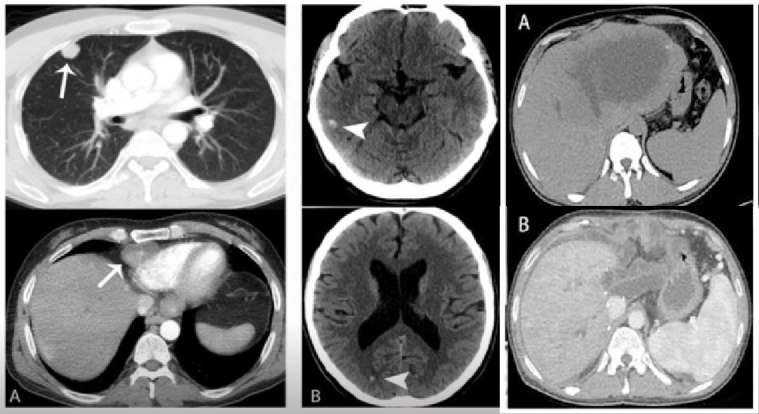 Images in Infectious Diseases: A Rare Cause of Alveolar Echinococcal Metastasis