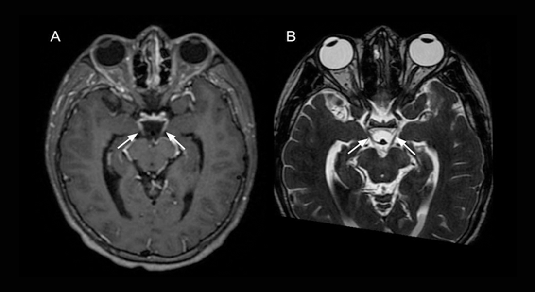 Bilateral oculomotor nerve palsy secondary to bacterial meningitis