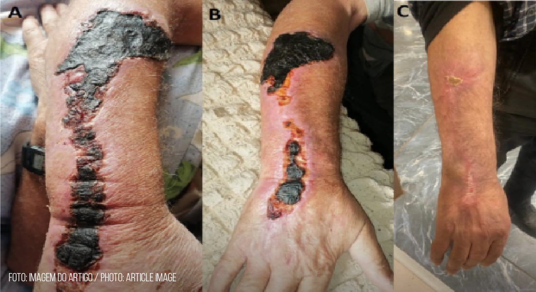 Case of severe bullous cutaneous anthrax case